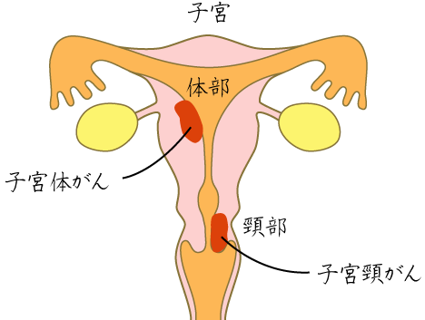 子宮頸がんは子宮の入口の頸部、内側の体部にできるがんです